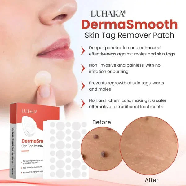 Derma Tag Remover – for Pimple, Acne & Tag Remover